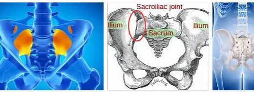 Sacroiliac Joint Syndrome